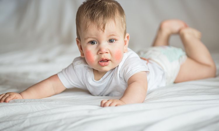 Skaza białkowa u dziecka, czyli alergia na białka mleka krowiego