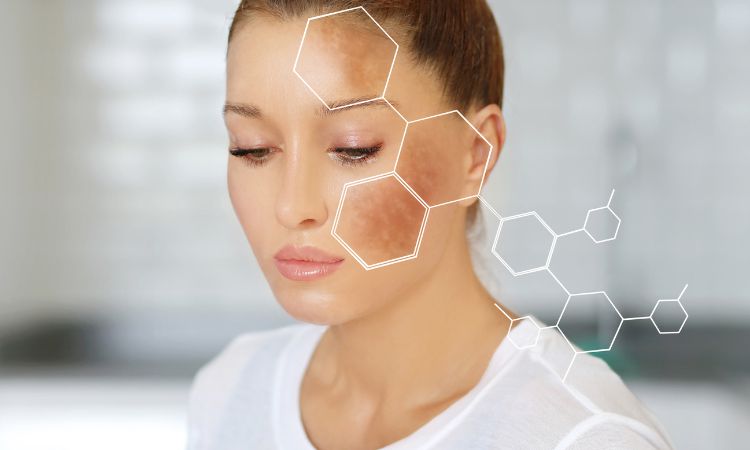 Czym jest ostuda (melasma), jak ją rozpoznać, leczyć i w jaki sposób jej zapobiegać?